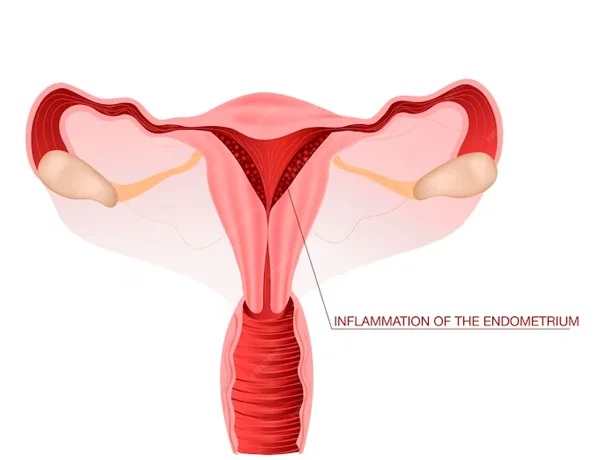 Endometriosis
